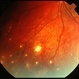 Multifocal Choroiditis